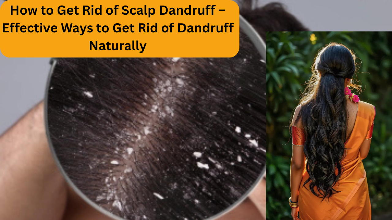 How to Get Rid of Scalp Dandruff – Effective Ways to Get Rid of Dandruff Naturally